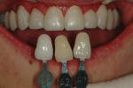 Figure 11. A photograph of the patient’s provisional with shade tabs to communicate the expected shade range to the dental laboratory.