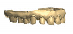 Figure 12. The tooth preparations scanned into the digital design software.