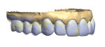 Figure 15. The definitive restoration design is overlaid with the provisional scan to verify that it conforms to the patient’s esthetic requirements.