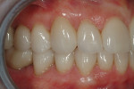 Figures 16 and 17. The patient’s final restorations have been equilibrated to establish bilateral simultaneous occlusion, demonstrated here by the interdigitation of the posterior teeth.