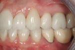 Figures 16 and 17. The patient’s final restorations have been equilibrated to establish bilateral simultaneous occlusion, demonstrated here by the interdigitation of the posterior teeth.