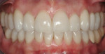 Figure 18. The definitive restorations shown in MIP.