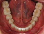 Figure 20. The final restorations on the mandibular arch with anatomy intact. Note the color match of the posterior PFM fixed partial denture on the patient’s left side with the rest of the restorations.
Ceramics by Chris Delarm, CDT.