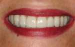 Figures 21 and 22. The patient’s esthetic expectations have been met, and the functional concerns for the longevity of her teeth have been addressed.