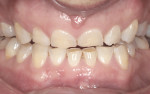 Figure 1. Extensive wear of tooth structures.