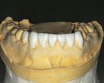 Figure 6. Mandibular diagnostic wax-up.