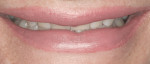 Figure 4. Full smile with minimal display of teeth.