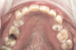 Figure 9. Occlusal view of the maxillary dentition, demonstrating no preparation on the majority of teeth and the removal of old restorations.
