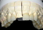 Figure 12. Lithium-disilicate restorations on
the model and demonstration of incisal
length increase.