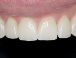 Figure 13. Completed restorations on
maxillary teeth.