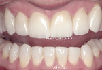 Figure 14. Retracted frontal view of maxillary
lithium-disilicate restorations and mandibular
direct resin composites.
