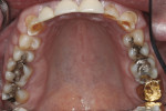 Figure 3. Upper arch before treatment.