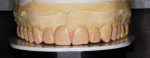 Figure 6. The diagnostic wax-up was done without preparing the teeth on the casts to visualize the additive nature of the restorations.