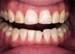 Figure 1  Preoperative view of teeth that are discolored by fluorosis.