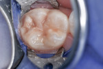 Figure 4 Occlusal sealant
stopped the sensitivity for at least 6 months.