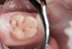 Figure 1 A malformed molar had sensitivity to cold stimulus and inspired air.