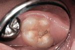 Figure 5 Large occlusal hypoplastic/hypocalcified lesion and caries.