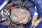 Figure 6 After rubber dam/orthodontic band isolation, the malformed and
carious tooth structure was debrided.