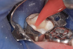 Figure 7 A resin-modified glass-ionomer (RMGI) liner was injected and light-cured.