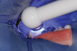 Figure 10 Each of the three nano-ionomer
portions was light-cured.