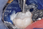 Figure 11 The occlusal surface was sculpted with slow-speed round diamond burs.
