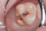 Figure 15 Significant enamel hypoplasia, enamel hypocalcification, and caries were evident.