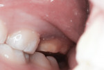 Figure 21 Occlusal clearance was evaluated.