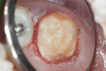 Figure 22 Tooth was conservatively prepared for a
stainless-steel crown.