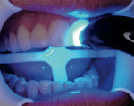 Figure 9  After removal of gross resin cement, the veneers were each polymerized for 5 seconds with a Sapphire Plasma Arc Light.