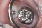 Figure 23 Stainless-steel crown seen in place 18 months after cementation.