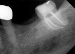 Figure 2 The curvature and calcification of the roots of the lower molar predisposes
this case to fracture of a nickel-titanium instrument.