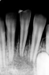 Figure 3 The open apices of the lower anterior tooth place it at high risk of extrusion if it is
not managed correctly.