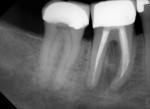 Figure 6 Using an orifice opener in the apical third led to file separation in the mesial root of tooth No. 30.