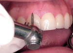 Figure 11  Fine finishing flame-shaped diamond removing excess resin cement and marginating the porcelain veneer.