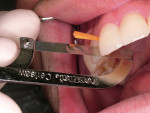 Figure 13  Opening the fused proximal contact with a CeriSaw; note the placement of the gingival wedge to avoid laceration of the gingival papilla.