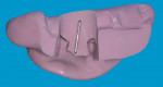 Figure 1  PVS putty impression with paper staplein estimated mesio-distal axis.