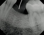 Figure 2  Radiograph depicting the trajectoryencroaching on the premolar root.
