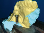 Figure 10  Placement of the laboratory analogafter the cast osteotomy, with the implant platformat the previously marked position.