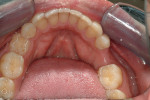 Figure 14  The intraoral condition, depictingthe missing premolar.
