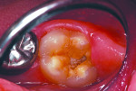Figure 3 A 7-year-old boy with enamel malformation and caries of permanent first molar.