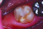 Figure 4 At 30 months after repair with resin-modified glass-ionomer liner overlaid with restorative cement.