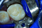 Figure 6 Resin-modified glass-ionomer liner placed.