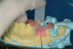 Figure 22  Application of PVS bite registrationmaterial incorporating H-frame. Note the positionof plastic tubing, which will facilitate exposingthe guided sleeve.