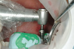 Figure 26  Clinical osteotomy guided by thesurgical guide and depth-stop on the twist drill.