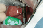 Figure 27  Dental implant readied for placementthrough the PVS surgical guide.