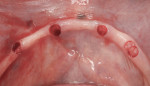 Figure 1 Tissue punches at implant sites on mandibular knife-edge ridge.
