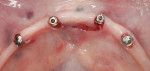 Figure 2 LODI implants
placed in mandible.