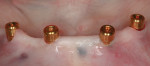 Figure 3 LOCATOR Attachments in place on the implants.
