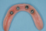 Figure 5 Denture caps picked up inside the denture base.