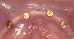 Figure 7 (7. AND 8.) View of implant
sites at 24-hour recall.